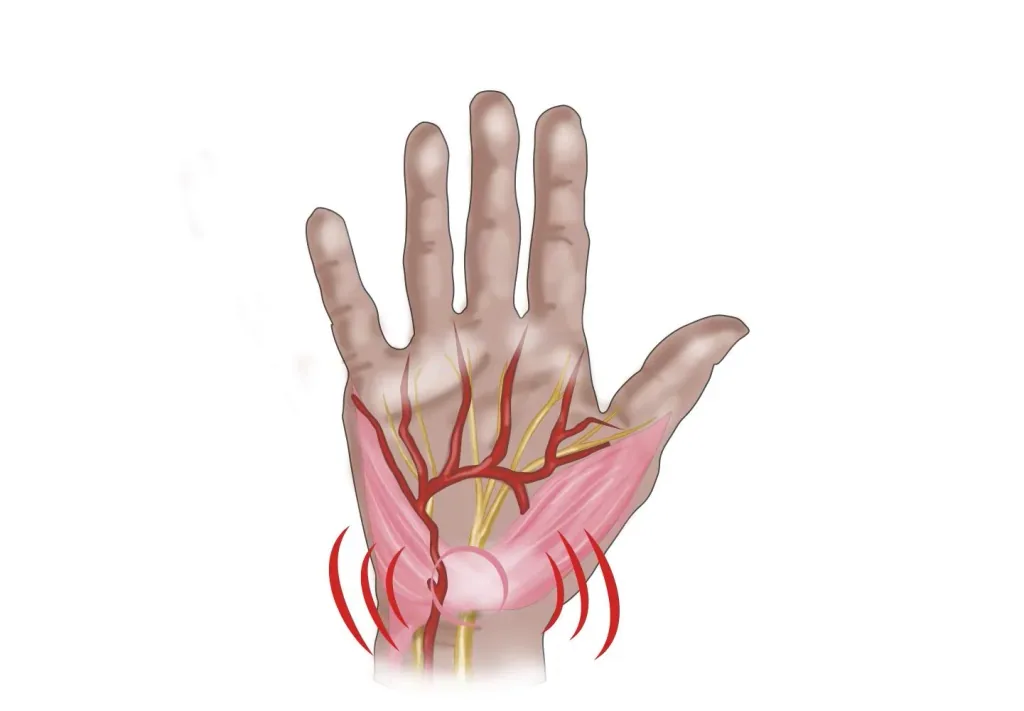 Handgelenkbandage bei Athrose und Karpaltunnel, rechts, 1 Stück